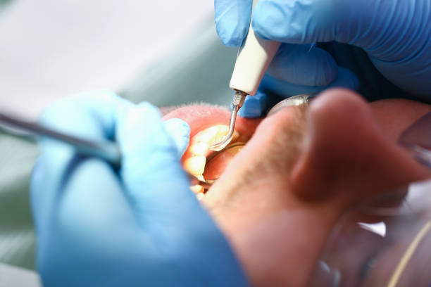 Best Knocked-Out Tooth (Avulsed Tooth) Treatment in Talpa, NM